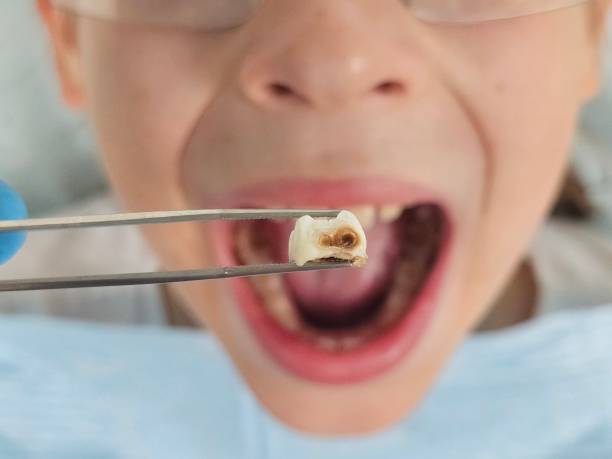 Best Emergency Dental Filling Replacement  in Mcelhattan, PA